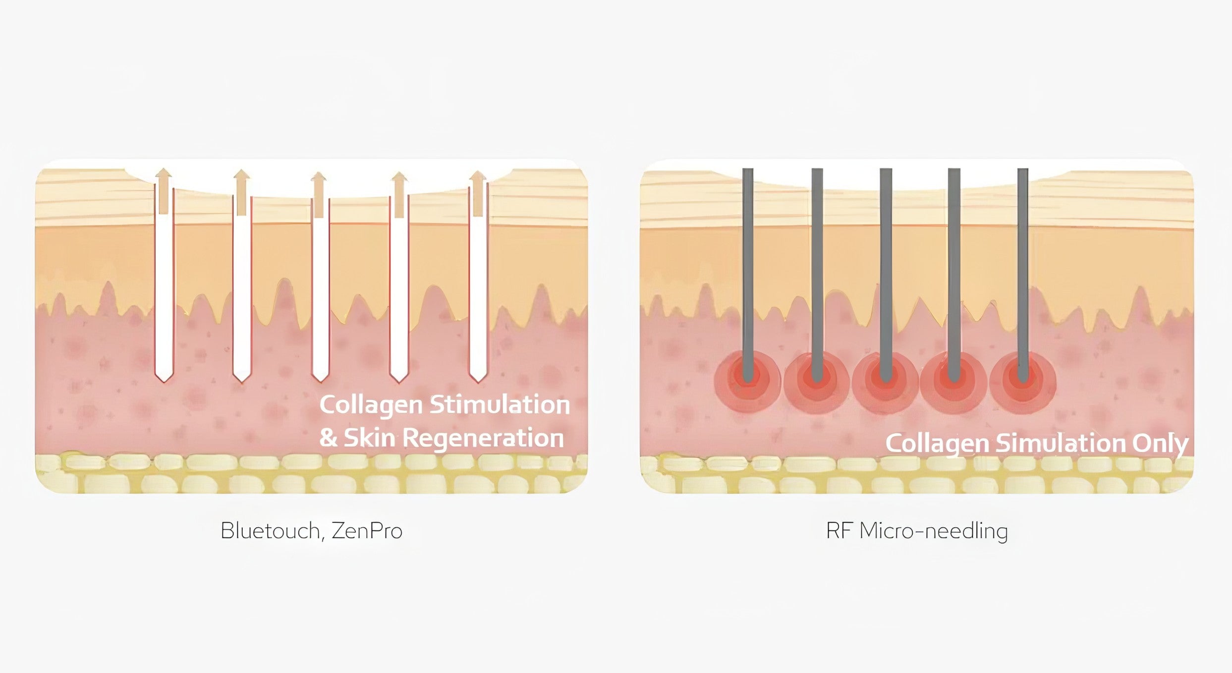 Diagram comparing collagen stimulation and skin regeneration with RF micro-needling on a white background. It is an ideal device purchase.