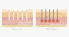 Diagram comparing collagen stimulation and skin regeneration with RF micro-needling on a white background. It is an ideal device purchase.