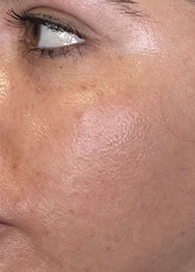 Versatile Fractional CO2 Laser System for Advanced Skin Rejuvenation & Private Health