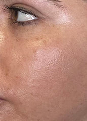 Versatile Fractional CO2 Laser System for Advanced Skin Rejuvenation & Private Health