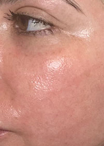 Versatile Fractional CO2 Laser System for Advanced Skin Rejuvenation & Private Health