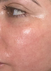 Versatile Fractional CO2 Laser System for Advanced Skin Rejuvenation & Private Health