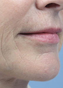 Versatile Fractional CO2 Laser System for Advanced Skin Rejuvenation & Private Health