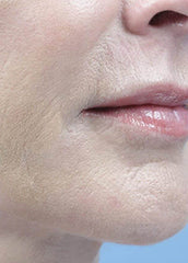 Versatile Fractional CO2 Laser System for Advanced Skin Rejuvenation & Private Health